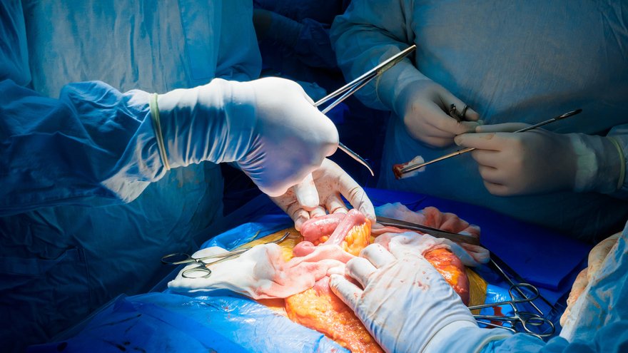 A team of surgeons performing abdominal surgery on a patient to remove a cancerous tumor in the intestines. Selective focus. Hands of surgeons during surgery on the abdominal cavity of a person.