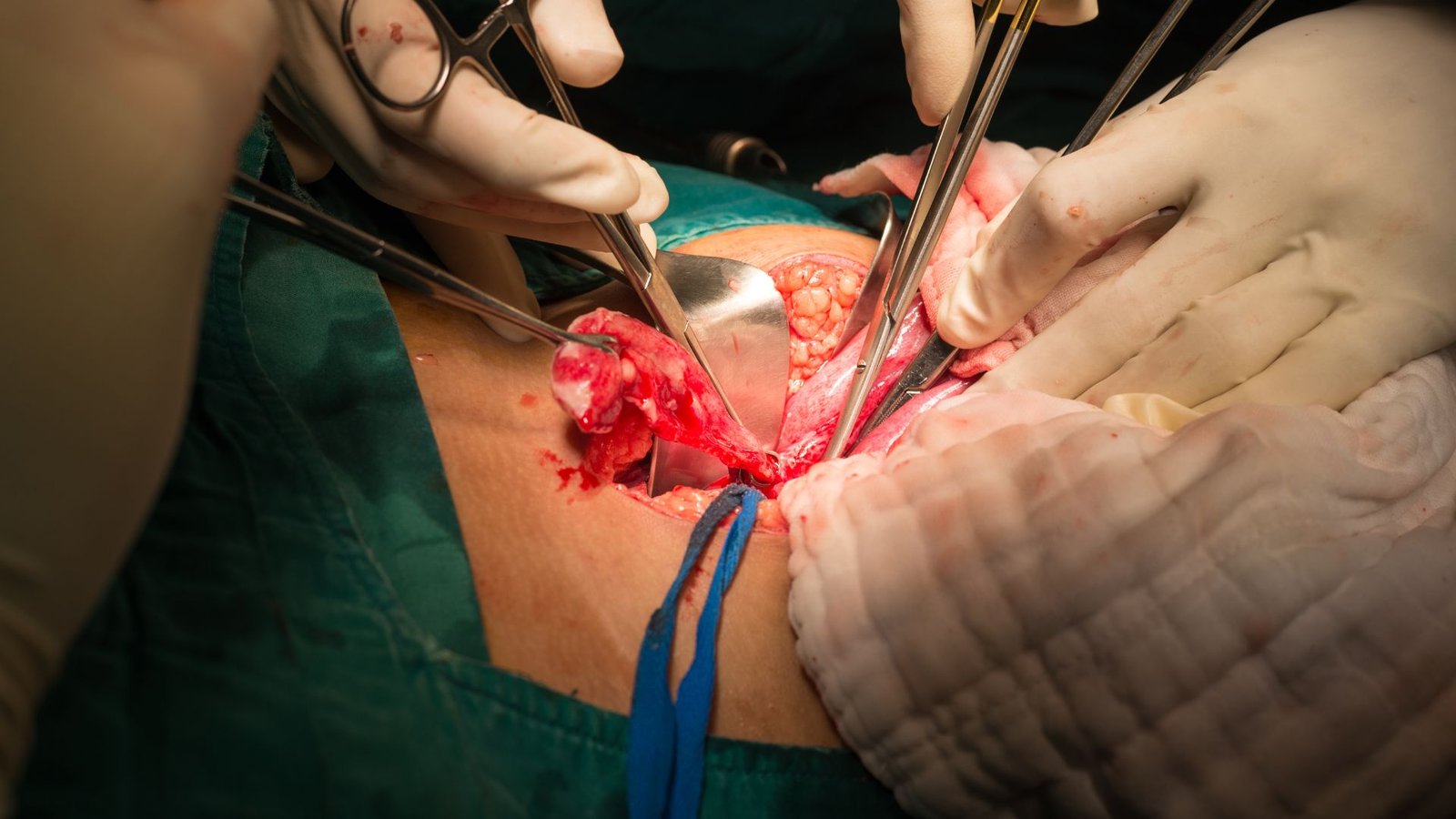 Apendicectomia-en-Panama