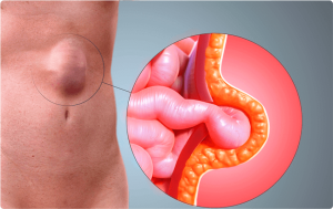 Hernias abdominales: ¿Cuándo operarse?