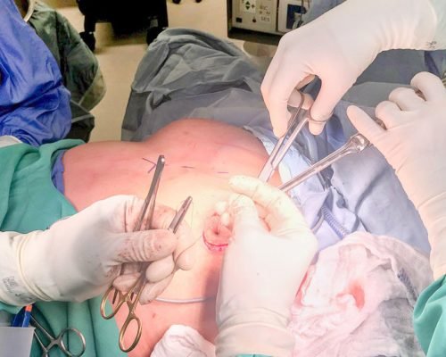 2021-11-18-breast-surgery-hero