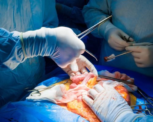 A team of surgeons performing abdominal surgery on a patient to remove a cancerous tumor in the intestines. Selective focus. Hands of surgeons during surgery on the abdominal cavity of a person.