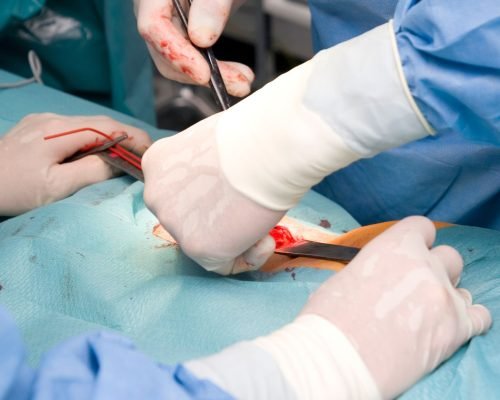 Cirugia-de-Hernia-Incisional-en-Panama