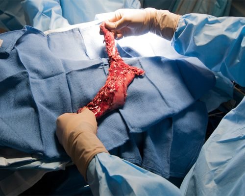 Esophagectomy (1)